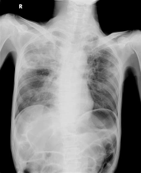 Chest Radiograph At Initial Showing Consolidation In Bilateral Upper