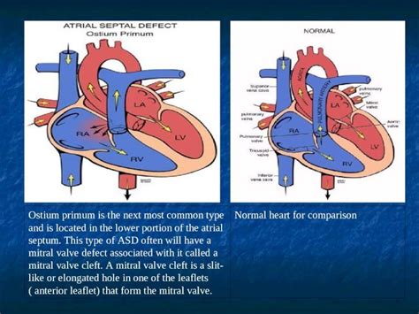 Atrial Septal Defect Ppt Powerpoint