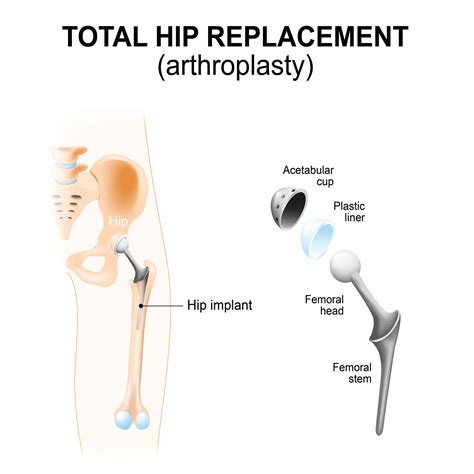 Types Of Hip Replacement Surgery In The Uk The Best Of Health