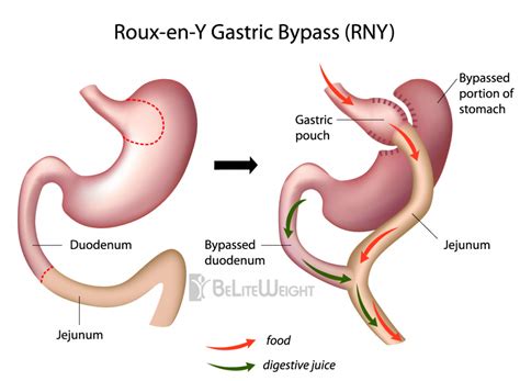 Roux En Y Gastric Bypass Type 2 Diabetic Weight Loss Beliteweight