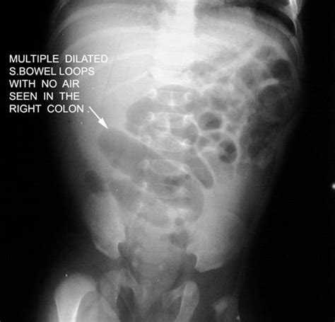 Dilated Loops Of Small Bowel Which Means Intestinal Obstruction Bowel