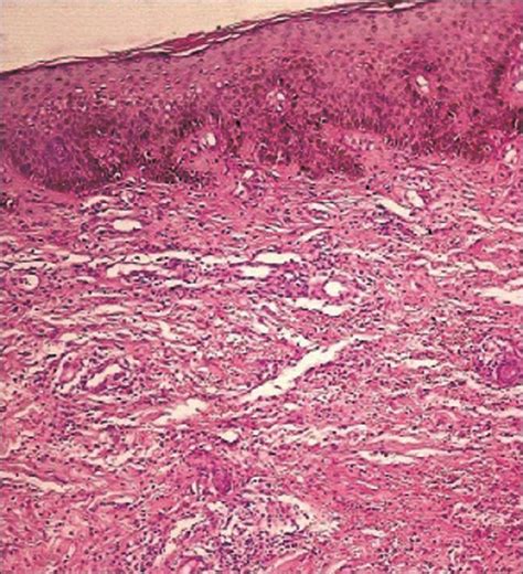 Bullous Pyoderma Gangrenosum Associated With Ulcerative Colitis