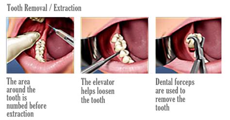 Oral Surgical Procedures Goa Dentist Dentist In Goa