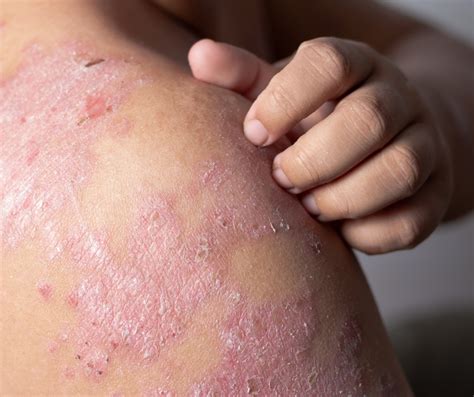 Sintético Imagen Fotos De Dermatitis En Las Manos Alta Definición Completa k k