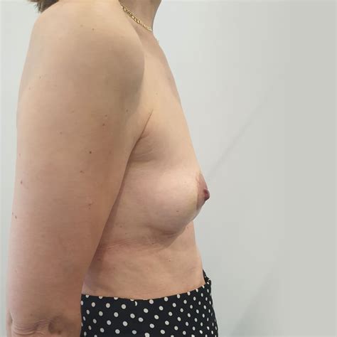 Removal Of Implants And Reconstruction Valverdeyarpino Es