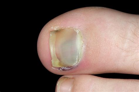 Bruised Toenail Photograph By Dr P Marazziscience Photo Library