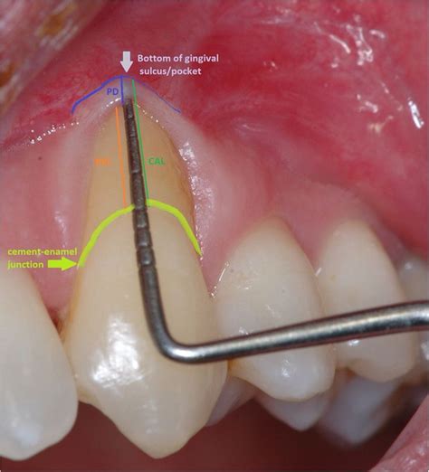 Gingival Sulcus Dental Dental Life Dentistry