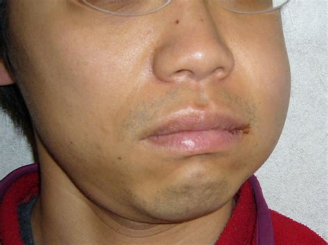 How To Stop Swelling After Wisdom Teeth Removal How To Reduce