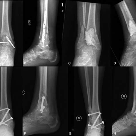 Infected Ankle Nonunion And Masquelet Technique Radiographs Of