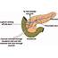 —Surgical Cannulation Of The Common Bile/pancreatic Duct And Ligation 