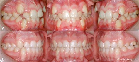 Peut On Faire De La Boxe Avec Un Appareil Dentaire - Quand faut-il avoir recours à des extractions dentaires ? - CISCO