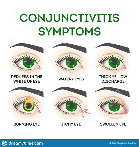 Conjunctivitis Symptoms Pink Eye Disease Infection And Allergy Stock