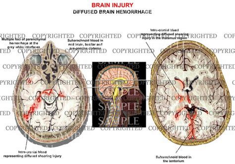 Brain Trauma Diffused Hemorrhage — Medical Art Works