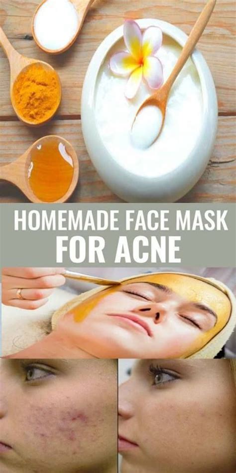 5 Homemade Acne Face Masks With All Natural Ingredients