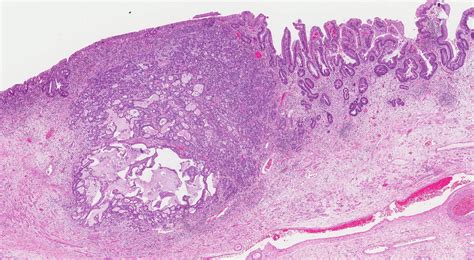 Adenocarcinoma Of The Esophagus Mypathologyreport Ca