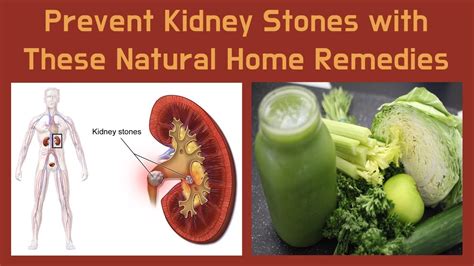 Prevent Kidney Stones With These Natural Home Remedies Youtube