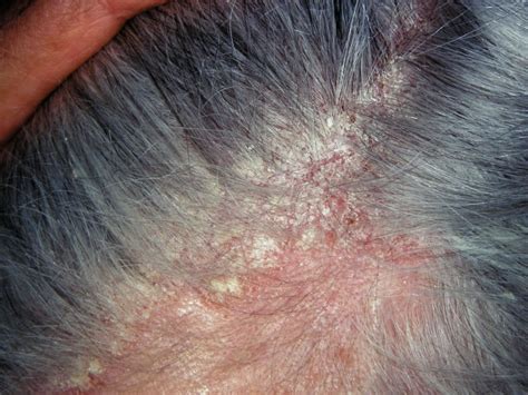 Seborrheic Dermatitis Hair