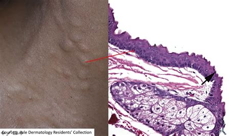 Dp60 Episode 76 Firm Papules Neck Youtube