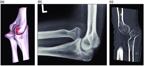 A To C Persistent Radial Head Dislocation Seven Years Following
