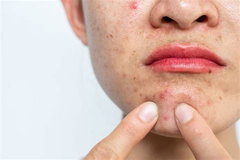 Pimples Breakouts And Blackheads Causes Symptoms Skin Renewal
