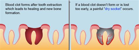 Others have the opposite experience and teeth shift a decade after braces. Tooth Extraction Aftercare - A Practical Guide - Healthrow.net