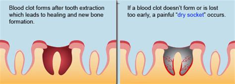 After a tooth extraction, blood fills the site where the tooth was. Tooth Extractions Encinitas CA