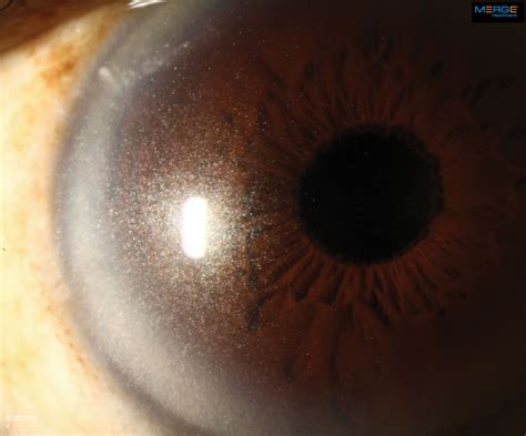 Aggregate More Than 128 White Ring Around Cornea Best Vn