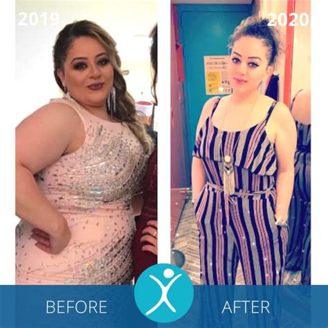 And my hair is different. Gastric Sleeve Before and After Photos - The Best Pictures ...