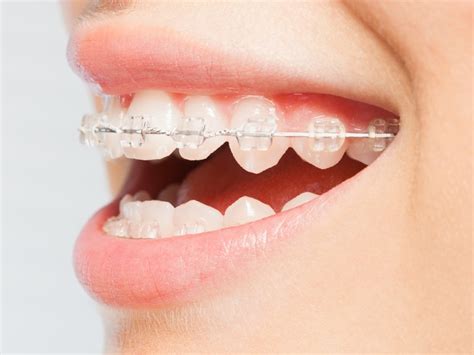 Metal Braces In Montgomery Tw Orthodontics Enterprise Braces