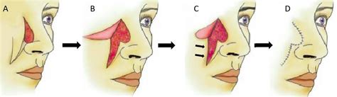 Rotation And Transposition Flaps In Facial Plastic And Reconstructive