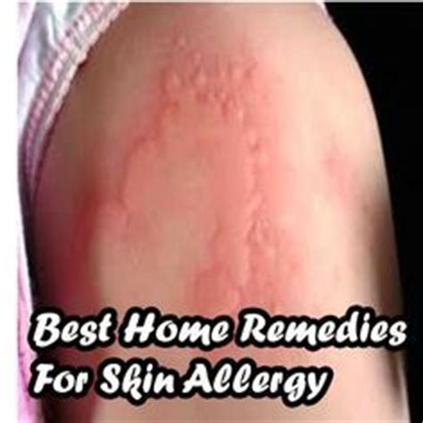 Organic coconut oil is one of the best home remedies to calm a rash. 10 Best images about Skin Allergy Remedies on Pinterest ...