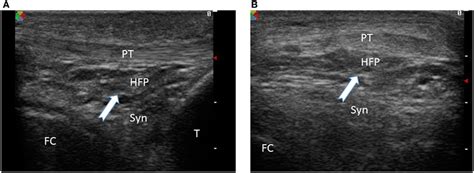 Ultrasound Image Of Infrapatellar Fat Pad Of A Normal Knee Joint