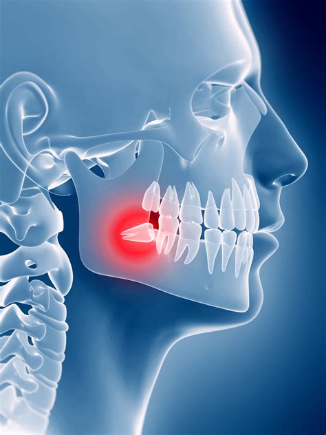 You got teeth ripped out of your mouth, you need to deal with the pain! How To Deal With Wisdom Tooth Pain After Extraction : Is ...