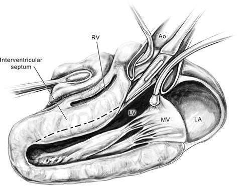 Ventricular Outflow Tract Obstruction In The Adult Thoracic Key