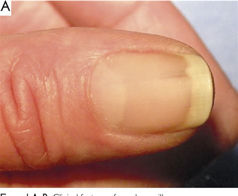 Pdf Onychopapilloma A Rare Tumour Of The Nail Apparatus Semantic