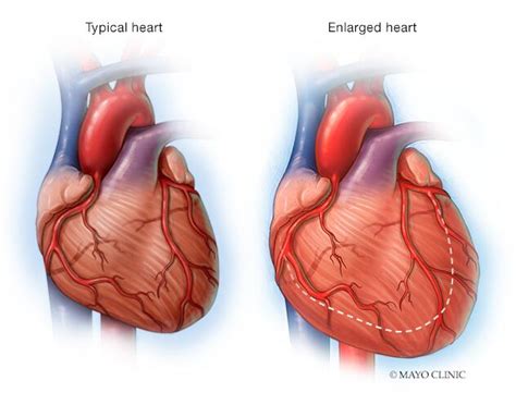 Corazón Dilatado Síntomas Y Causas Mayo Clinic