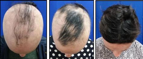 Experimental Pill Prompts Some To Regrow A Nearly Full Head Of Hair