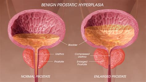 Benign Prostatic Hyperplasia