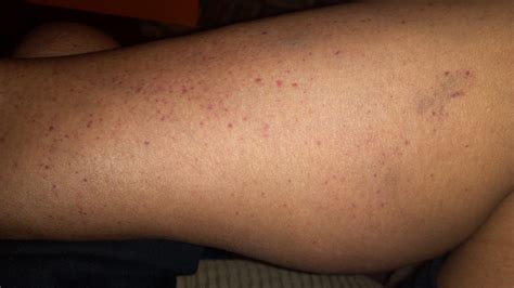 Red Splotches On Leg Pictures Photos