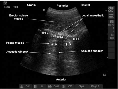 Figure 1 From Ultrasound Guided Lumbar Plexus Block Through The