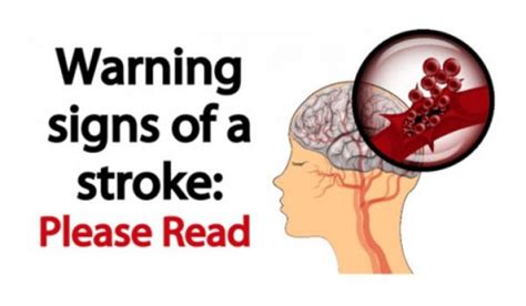 6 Early Warning Signs Of Stroke Everyone Should Know Central Kasoa Clinic