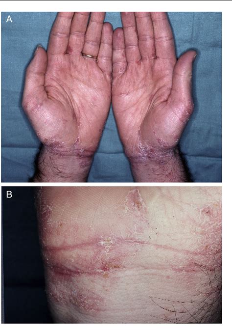 Figure 2 From Treatment Of Human Scabies With Oral Ivermectin