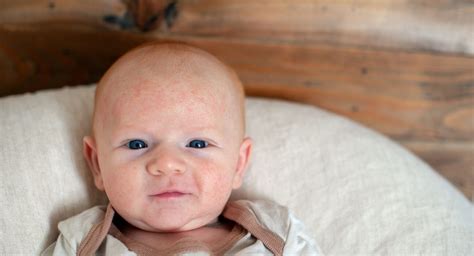 Atopijski Dermatitis Kod Beba Bebe Hr