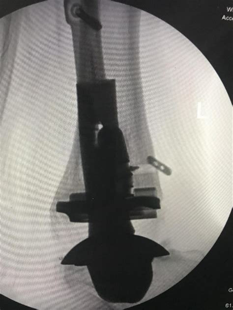 Total Ankle Arthroplasty With Custom Prosthetic Fibular Implantation
