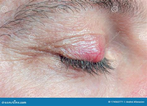 Chalazion On The Eyelid Of A Man Close Up Stock Image Image Of