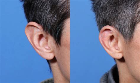 Smaller Ears With Macrotia Surgery Performed By Dr John Hilinski