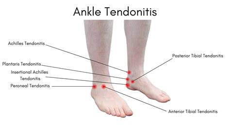 Ankle Tendonitis Learn What Causes Ankle Tendonitis