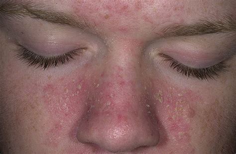 Seboroi Ni Dermatitis Uzroci Simptomi I Lije Enje Mojdoktor Ba