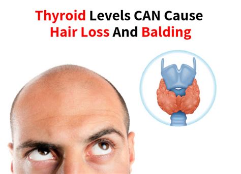 Angiotensin ii receptor blockers don't seem to list hair loss as a side effect, even rare. Thyroid levels CAN cause hair loss and balding - Hair Loss ...