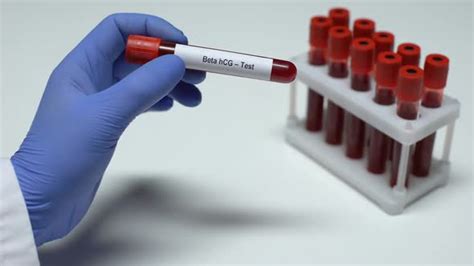 Beta Hcg Test Doctor Showing Blood Sample In Tube Lab Research